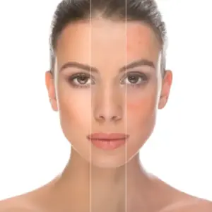 apvmediclinic Acne